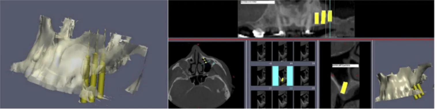 FIGURE 1. Detailed planning of patients was conducted by using three-dimensional implant software over cone-beam CT data.