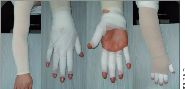 Figure 4. The  application of  short-stretch and  non-elastic compression  bandages.