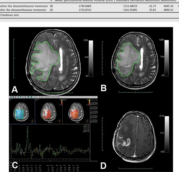 Fig. 4 – 72 years-old female patient with high grade glioma (gliosarcoma). (A) T2 axial sections edema was marked