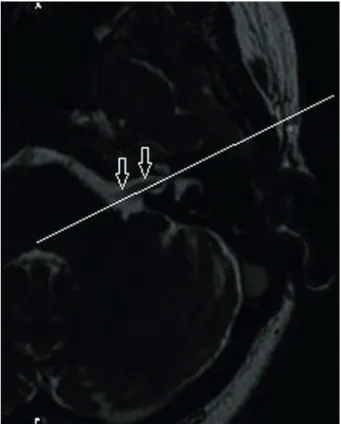 Figure 2. Oblique sagittal three-dimensional fast imaging  employing steady-state acquisition (3D-FIESTA) image nearest  the fundus of the internal auditory canal (IAC) showing the  facial nerve (white arrow), the cochlear nerve (blue arrow), and  the supe