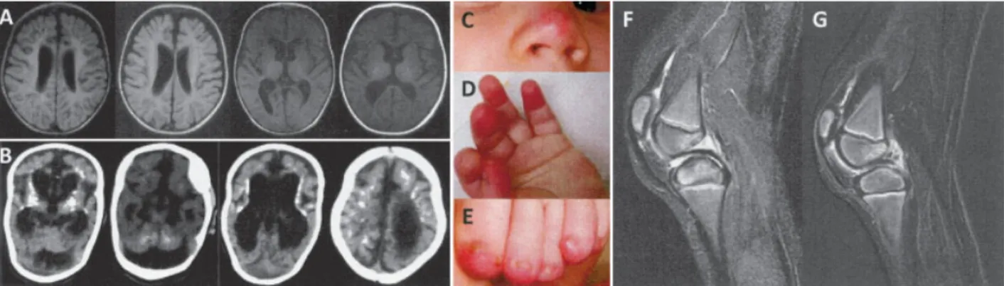 Figure 1. Imaging findings and cutaneous signs in patients with Aicardi-Goutie `res syndrome (AGS)