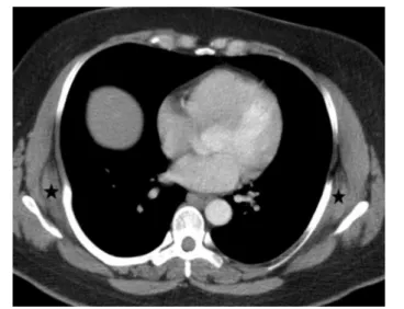 Fig. 2. Axial contrast-enhanced CT image of thorax in mediastinal window demonstrates bilateral crescent-shaped soft-tissue masses located in subscapular regions consistent with ED ( ﬁve-pointed stars).