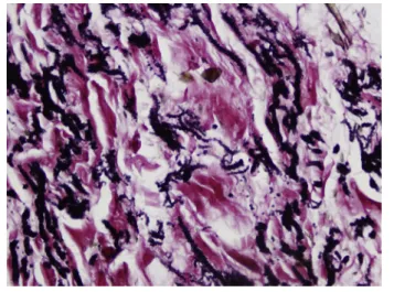 Fig. 3. Microscopic appearance of the lesion. Elastic stain (Elastica Von Gieson) x 400, reveals deeply staining, branched and unbranched ﬁbers that have a central dens core and irregular moth-eaten or serrated margin.