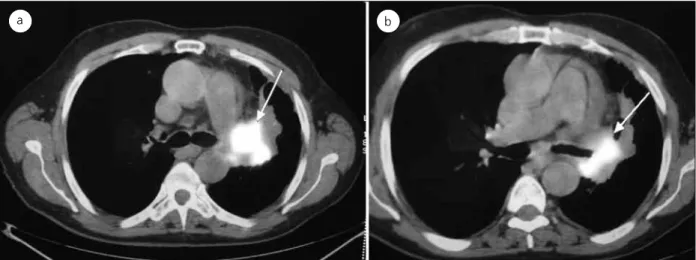 Figure 2. PET-CT showed  pathological activity on the  medial cruris  of the left surrenal gland (SUV max: 4.01)