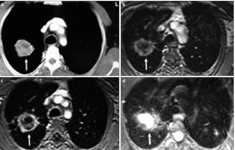 Figure 1. a–d. Axial plane CT (a), pre-contrast VIBE (b), contrast-enhanced VIBE (c), and HASTE MR (d) images of a 47-year-old coal worker  who presented with huge progressive massive fibrosis lesion on the right side (white arrows).