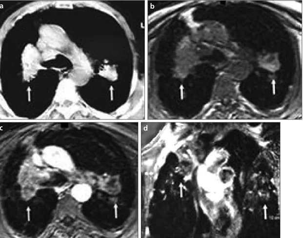 Figure 3. a–d. Axial plane CT (a), pre-contrast VIBE (b), and contrast-enhanced VIBE MR (c) images of a 52-year-old coal worker with a 20-year  underground working history who had progressive massive fibrosis lesions on each lung (white arrows)