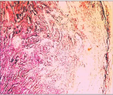 Figure 3. Basal layer of tumoral cells forming tubular like structures in  fibrous tissue staining PAS positive (HE×20).