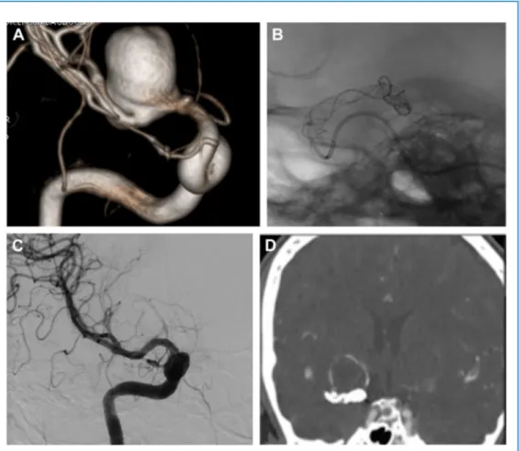 Figure 2. Case 13. Images obtained in a 65-year-old man with a ruptured right-sided middle cerebral artery (MCA) M1 segment aneurysm