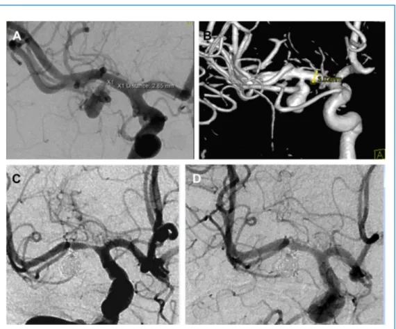Figure 3. Case 3. Images obtained in a 42-year-old woman with a nonruptured right-sided middle cerebral artery (MCA) variant bifurcation aneurysm at the origin of the right anterior temporal artery