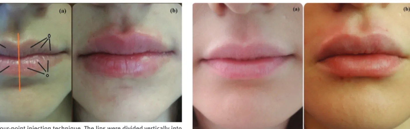 Figure 2 |  (a) Before and (b) immediately after the lip augmentation procedure.