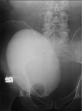 FIGURE 1: On cystographic examination the bladder seems to be normal ex- ex-cept for lateral displacement reminding compression of a neighbouring mass.