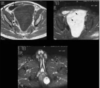 FIGURE 2: T1-weighted axial MR image (A) reveals a well-defined huge pelvic mass displacing the bladder anterolateraly (short arrow) and rectum  lat-erally (long arrow)