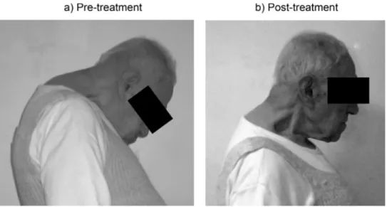 FIG. 1. (a) Prominent antecollis in a patient diagnosed with Parkinson’s disease; (b) Resolution of head drop after administration of anticholines- anticholines-terase therapy.