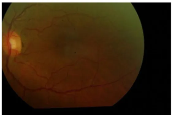 Fig. 4 Increased tortuosity and multiple fusiform aneurysms along the inferior and superior temporal retinal veins and fine telangiectatic capillaries temporal to macula