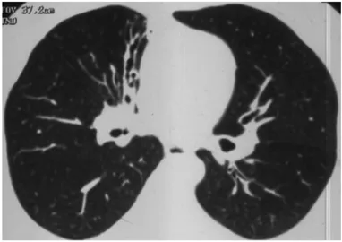 FIG. 1. Bronchiectasis is seen at right paramediastinal area.