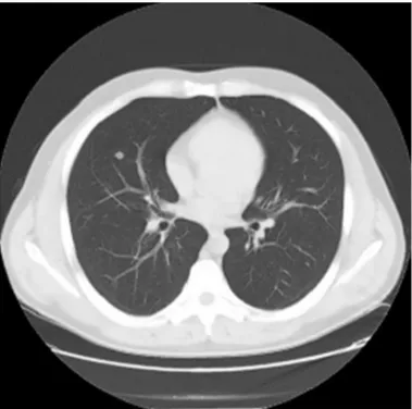 FIG. 3. There is a parenchymal solitary pulmonary nodule in the middle  lobe of the right lung.
