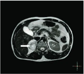 Figure 1. Abdominal MRI showes a solid mass of right adrenal gland with regular borders and heterogeneous contrast uptake.