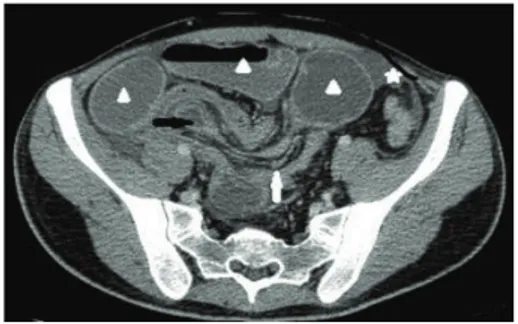 Figure 1: Contrast enhanced axial MDCT image demonstrates the presence of intussusception (black arrow) with an accompanying complex of mesenteric fat and blood vessels (white arrow)