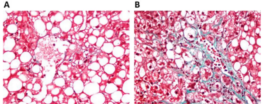 Figure 1 A. Mild ﬁbrosis in non-alcoholic steatohepatitis. B. Advanced ﬁbrosis in non-alcoholic steatohepatitis.