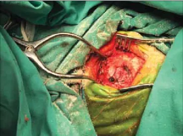 Figure 3: Irrigation of in-situ PMMA to prevent heat and associated 