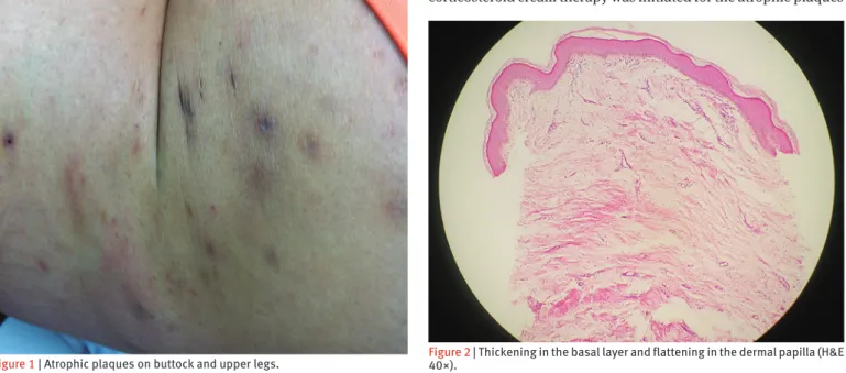 Figure 1 | Atrophic plaques on buttock and upper legs. Figure 2 | Thickening in the basal layer and flattening in the dermal papilla (H&amp;E  40×).