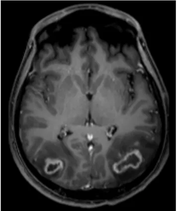 Fig. 1c. Sagittal view of the abscess on T1-weighted post-contrast MRI.