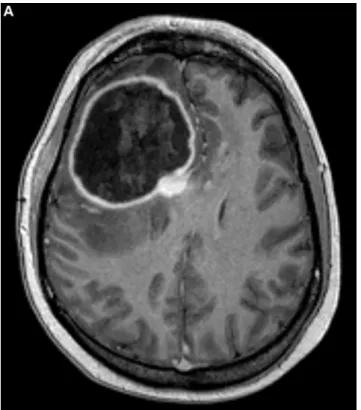 Fig. 3b. Uniform, slender, acutely branching fungal hyphae consistent with Aspergillus in necrosis around vessels (Gomori’s Methenamine silver stain, 200).