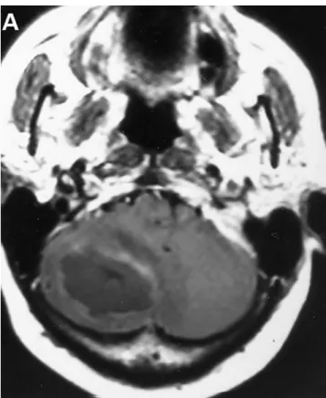 Fig. 5b. No lesion can be seen after surgery and systemic antifungal therapy (4) (From Neurosurgery, with permission).