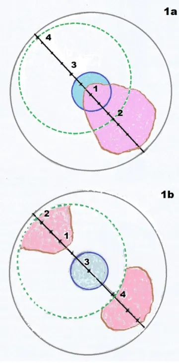 Figure 1. Schematic picture of cornea with opacity involving pupillary area. The  center  of  the  cornea  is  marked  (1),  and  a  point  2.5  mm  away  from  center  is  marked in the opacity (2), third mark is made 2.0 mm away from the central mark,  i
