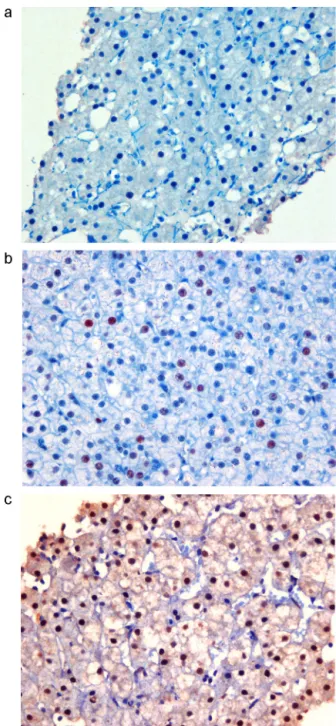 Fig. 1. Various degrees of estrogen receptor-alpha expression: no expression (a), weak expression (b), and strong expression (c) in patients with chronic hepatitis C.