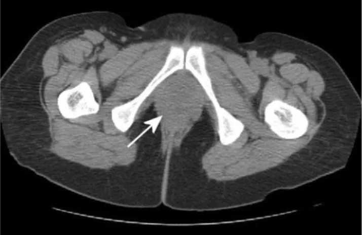 Fig. 1.  Transvaginal sonogram. The diverticulum is fi lled with the  tumor mass