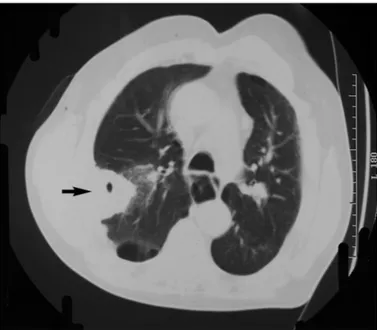 Figure 3. CT scan of the chest. Arrow indicates a mass in the upper  lobe of right the lung with a hypodense necrotized center