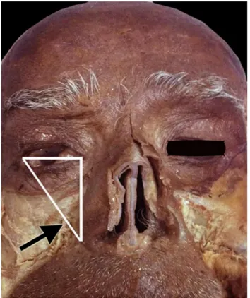 Fig. 1 The soft tissue landmarks (lateral edge of the ala of the nose, medial and lateral palpebral commissures) and the triangular shaped region formed by connecting all these three soft tissue landmarks were shown
