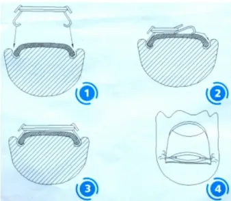 Figure 1. Application of nail brace with two hooklike projec- projec-tions on the sides, and a dental string in the middle pulling the sides of the nail upwards.