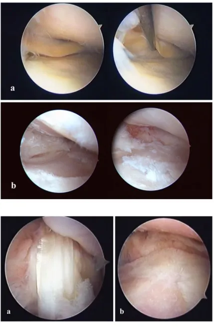 Fig. 1 a A 26-year-old male patient, 5 years after index surgery (arthroscopic appearance at second-look examination)