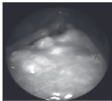 Fig. 1. Flexible laryngoscopy showing a large mass of the epiglottis that did  not impair vocal fold mobility, but did cause dysphonia through a mass effect  on the supraglottic.