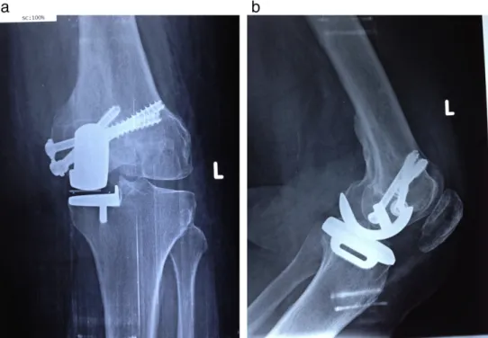 Fig. 2. a) Anterioposterior X-ray view 6 weeks after surgery. b) Lateral X-ray view 6 weeks after surgery.