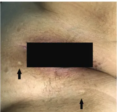 Figure 1 | Hypopigmented atrophic scars on the perineum.