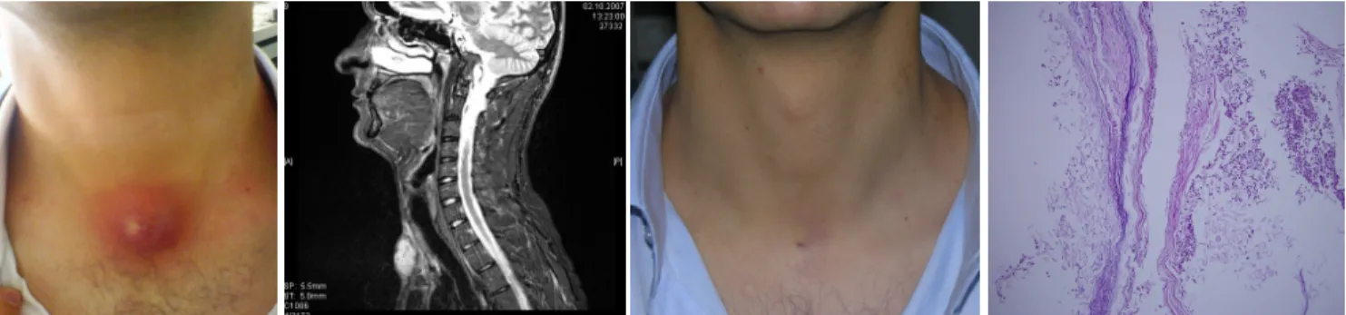 Figure 4. Keratinous cyst of epidermal type  with secondary inflamation.