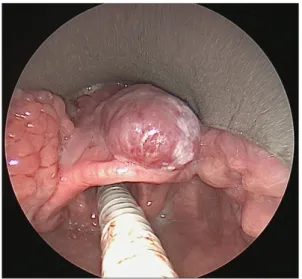 Fig. 4 – One year post-operative view showing healed epiglottis with no recurrence of lesion.