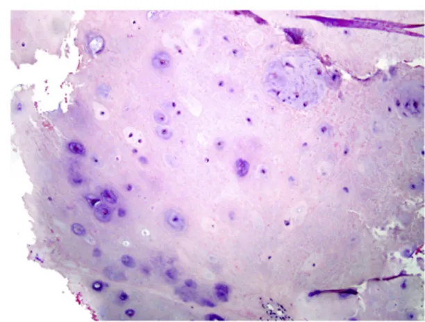 Fig. 10 – Axial CT scan demonstrating expansile lesion in the right postero-lateral cricoid.