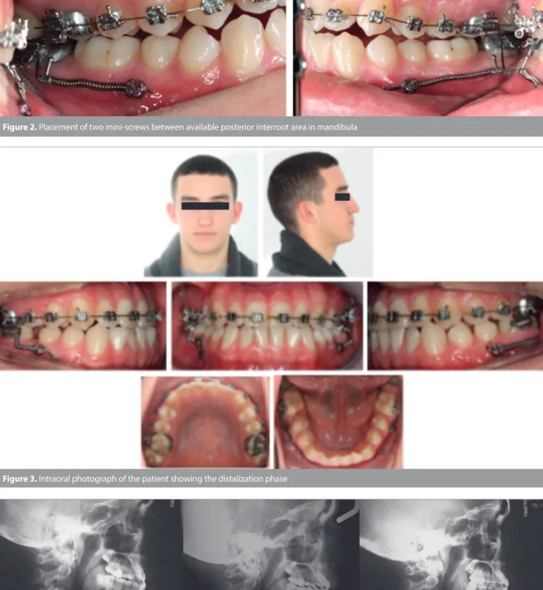 Figure 4. Lateral cephalograms of patient were taken at prior to treatment (T0), at the end of treatment (T1), after postretention period (T2)