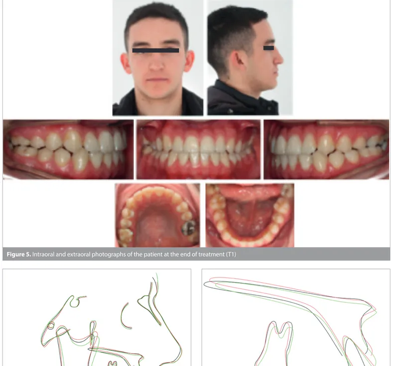 Figure 7. Local maxillary superimpositions