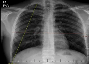 Figure 1 Chest height and transverse diameter measure- measure-ment on posteroanterior chest radiography.