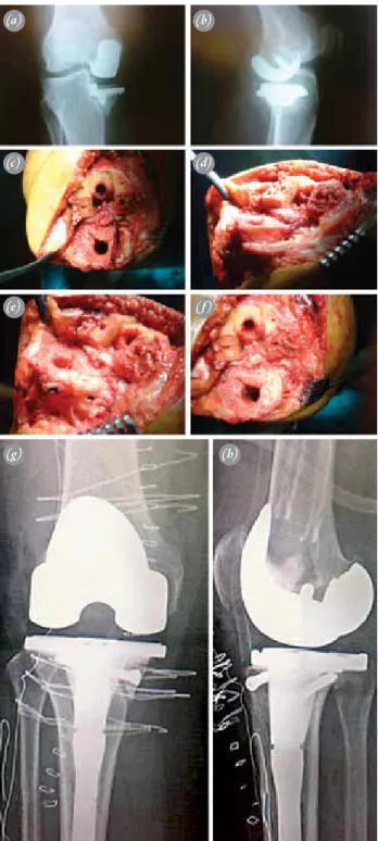 Fig. 2.  Case of a 54-year-old female patient who underwent ce- ce-mented unicompartmental knee replacement at another  hos-pital