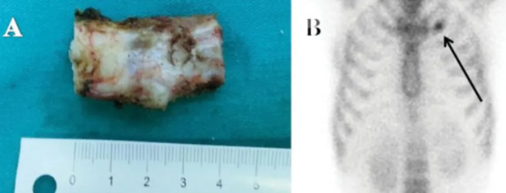 Fig. 1 (A) A 50-year-old woman ’s chest X-ray after 9 months of her ﬁrst admission shows an expansion and calciﬁcation on the costochondral junction of the right third rib (arrow)