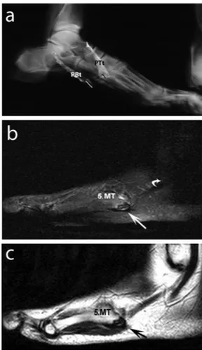 Fig. 2. Schematic drawing of the classiﬁcation of the tendon insertion characteristics of the PB (peroneus brevis); Types 1a–IIIb.