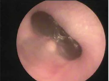 Figure 1. Tympanic membrane perforations in the posteroinferior part of the  pars tensa.