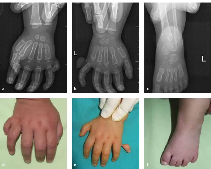 Şekil 2. a-f. Her iki elde ve sol ayakta basit polidaktilisi olan ve basit eksizyon yapılan 2 yaşındaki erkek hastanın radyolojik ve  preoperatif görüntüleri (a) sağ el grafisi (b) sol el grafisi (c) sol ayak grafisi (d) sağ el preoperatif görüntüsü (e) so