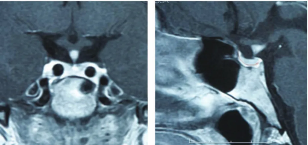 Figure 1. MRI imaging of the patient in 2008 showing the central homogenous symmetrical bright contrast enhanced area in hypophysis, and intact sellar floor, typical for lymphocytic hypophysitis.